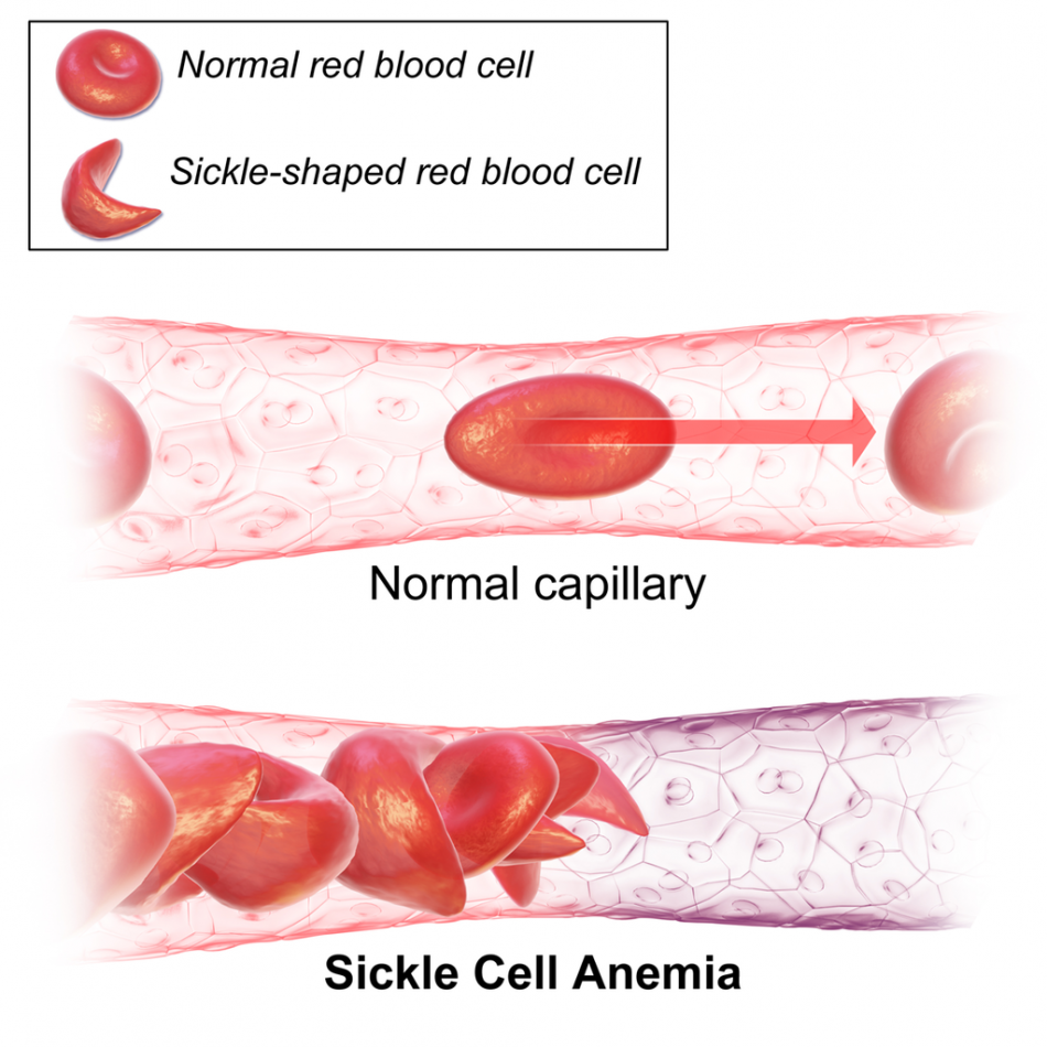 Comfort Okolo, Sickle cell
